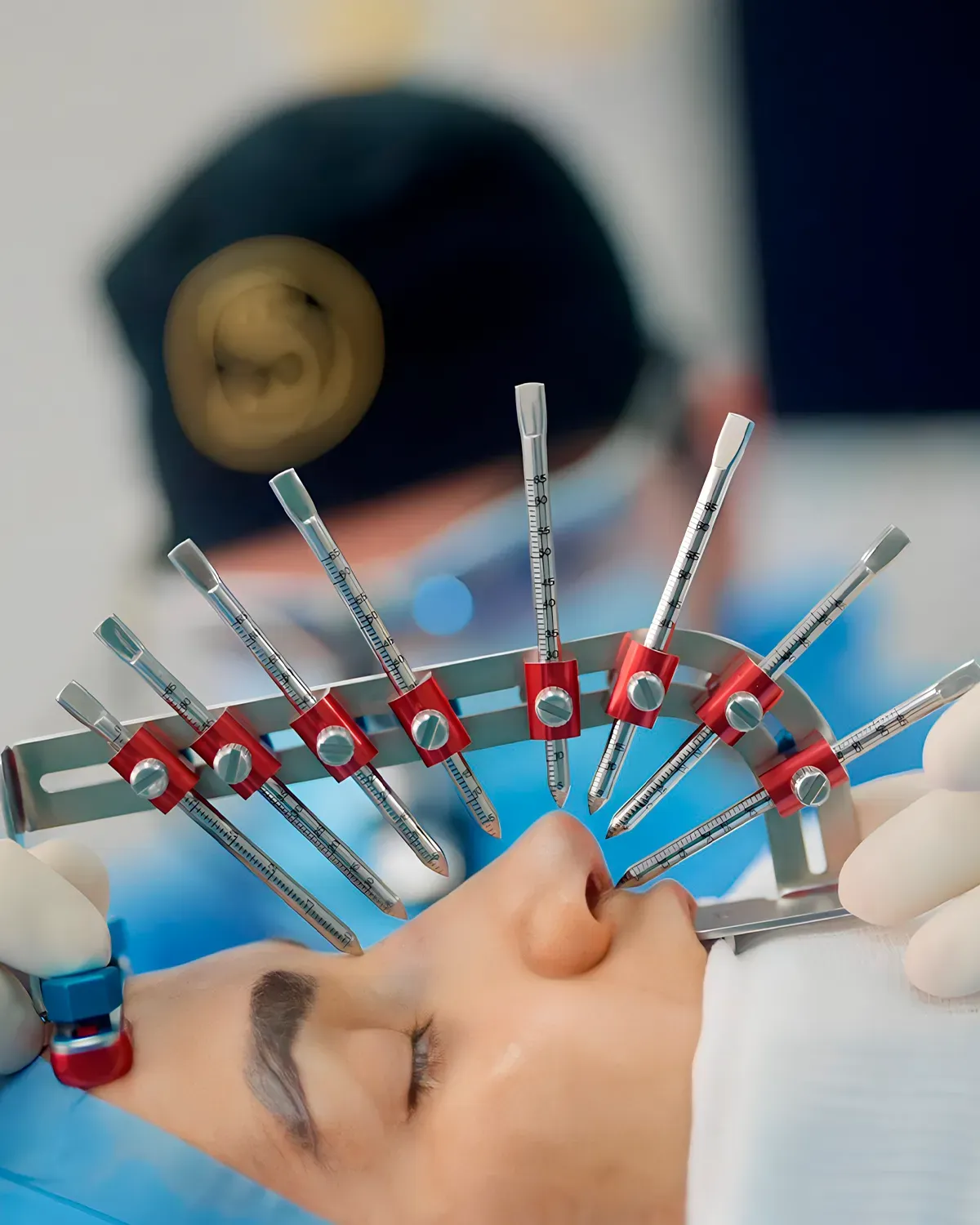 Rinoplastia Escultural